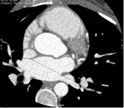 ctscan
